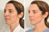 Rhinoplasty case #4217 slider thumbnail