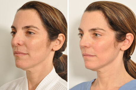Rhinoplasty case #4217