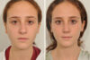 Rhinoplasty case #4252 slider thumbnail