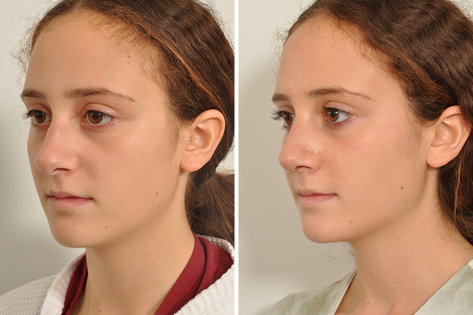 Rhinoplasty case #4252