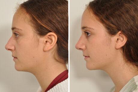 Rhinoplasty case #4252