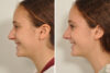 Rhinoplasty case #4252 slider thumbnail