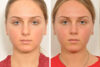 Rhinoplasty case #4247 slider thumbnail