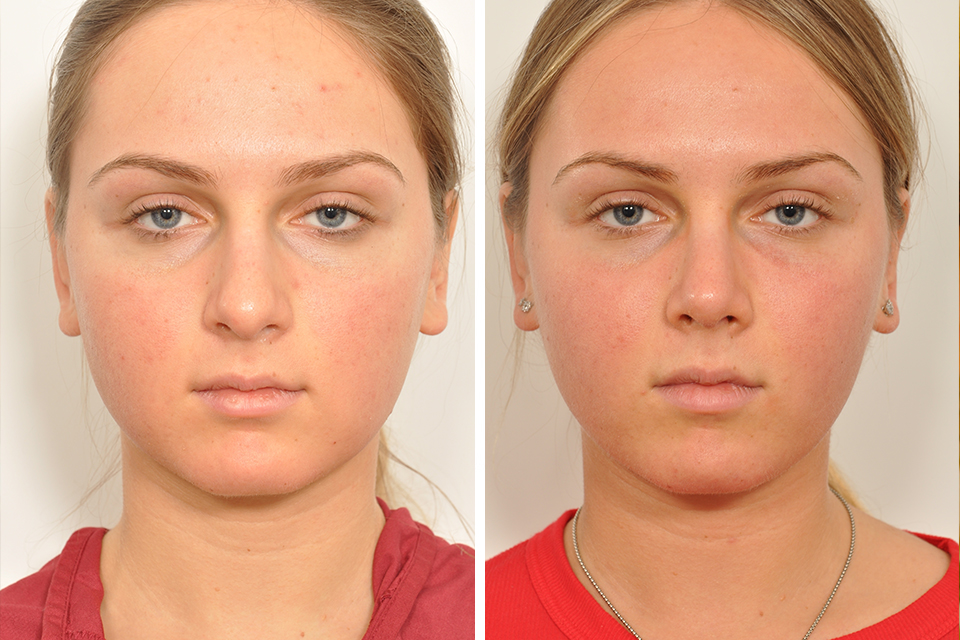 Rhinoplasty case #4247