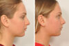 Rhinoplasty case #4247 slider thumbnail