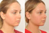 Rhinoplasty case #4247 slider thumbnail