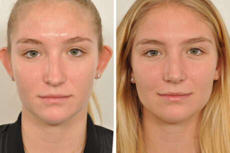 Rhinoplasty case #4232
