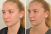 Rhinoplasty case #4232 slider thumbnail