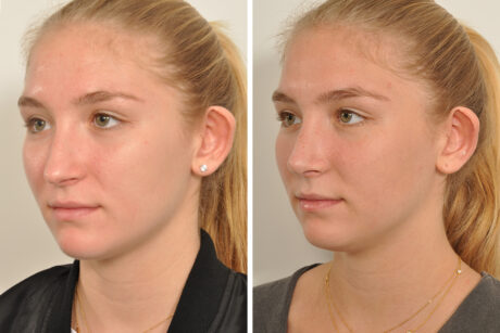 Rhinoplasty case #4232