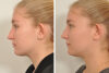 Rhinoplasty case #4232 slider thumbnail
