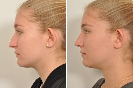 Rhinoplasty case #4232