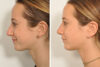 Rhinoplasty case #4240 slider thumbnail