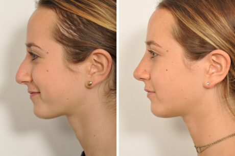 Rhinoplasty case #4240