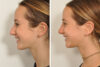 Rhinoplasty case #4240 slider thumbnail