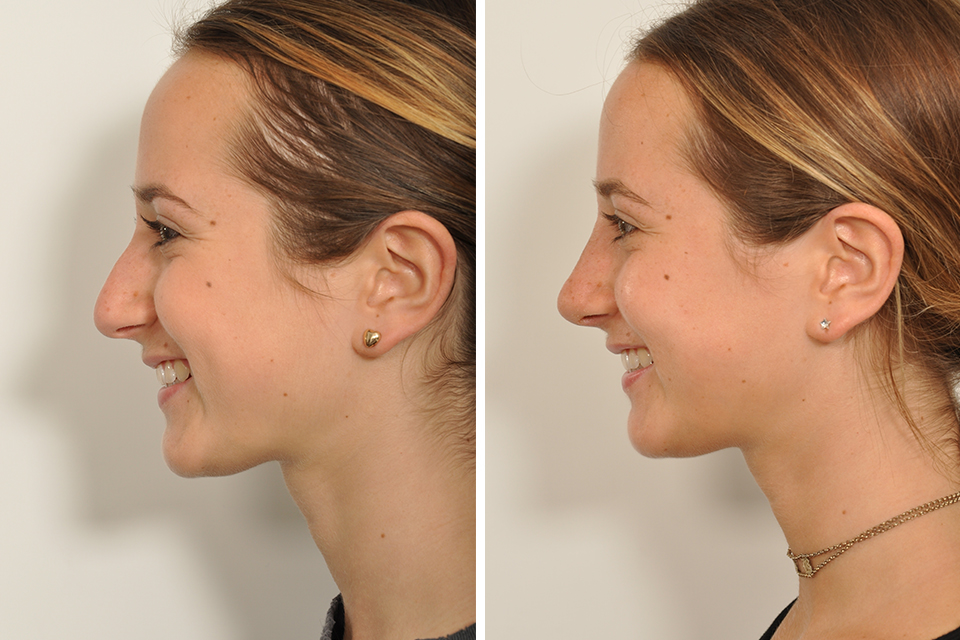 Rhinoplasty case #4240