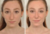 Rhinoplasty case #4236 slider thumbnail