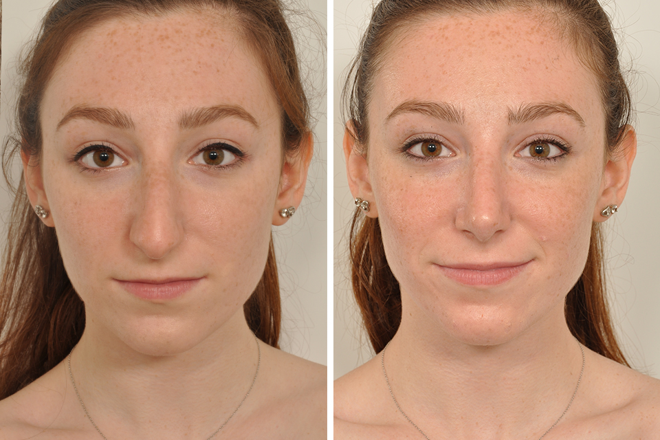 Rhinoplasty case #4236