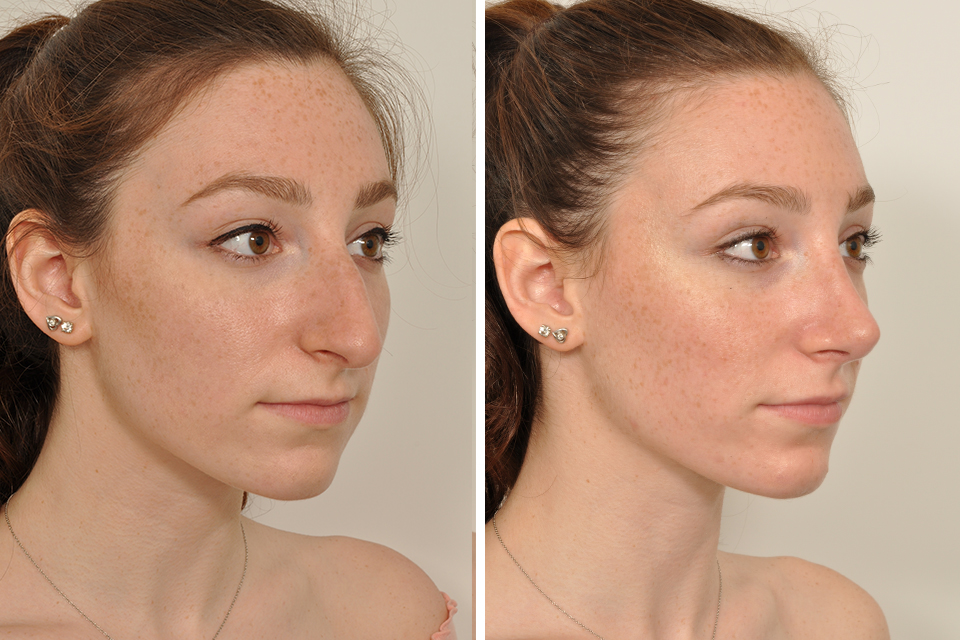 Rhinoplasty case #4236