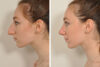Rhinoplasty case #4236 slider thumbnail