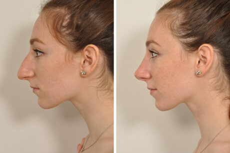 Rhinoplasty case #4236
