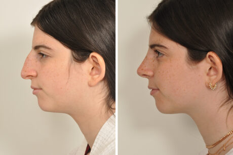 Rhinoplasty case #4128