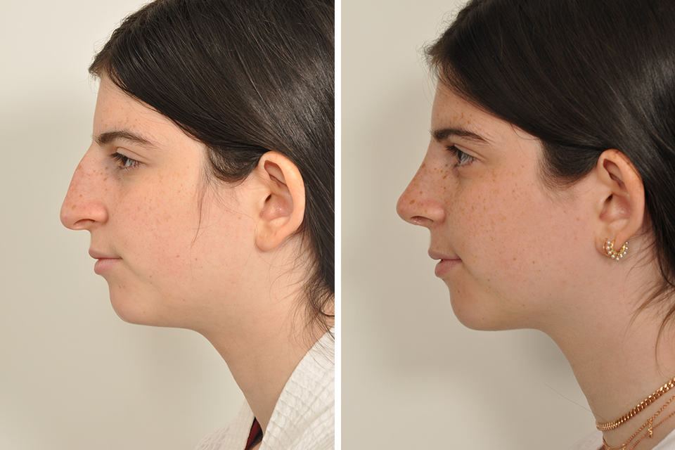 Rhinoplasty case #4128