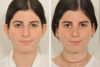 Rhinoplasty case #4128 slider thumbnail