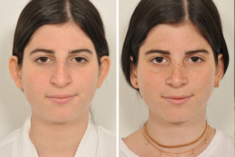 Rhinoplasty case #4128