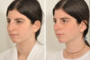 Rhinoplasty case #4128 slider thumbnail