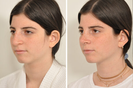 Rhinoplasty case #4128