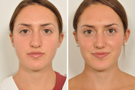 Rhinoplasty case #4188