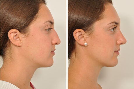 Rhinoplasty case #4188