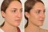 Rhinoplasty case #4188 slider thumbnail