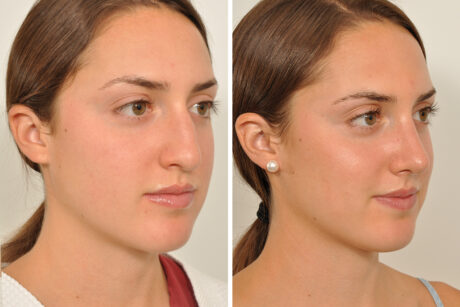 Rhinoplasty case #4188