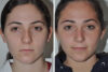 Rhinoplasty case #4213 slider thumbnail