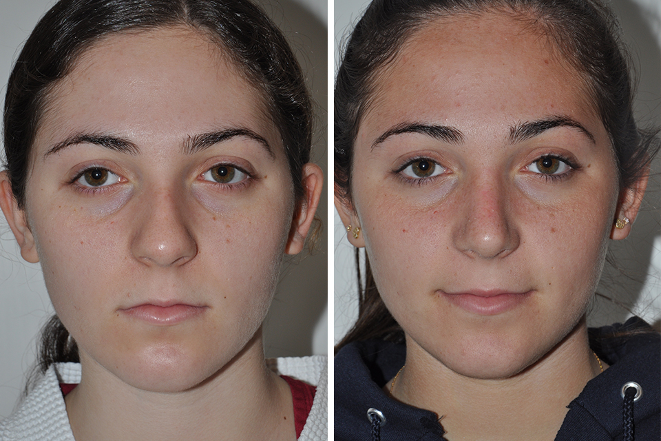 Rhinoplasty case #4213