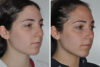 Rhinoplasty case #4213 slider thumbnail