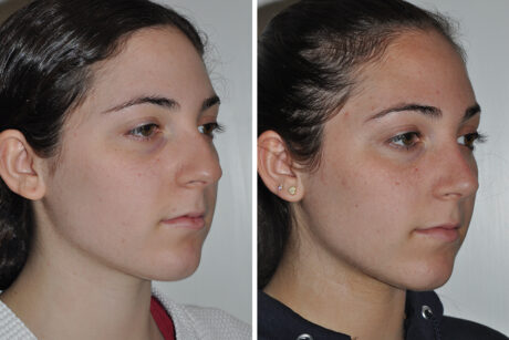 Rhinoplasty case #4213