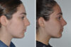 Rhinoplasty case #4213 slider thumbnail
