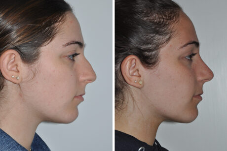 Rhinoplasty case #4213