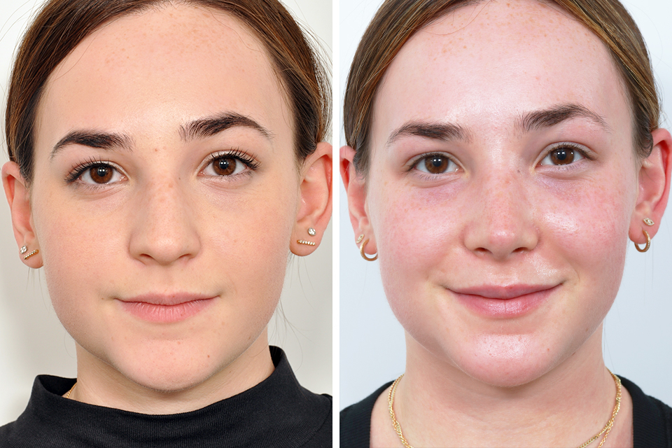 Rhinoplasty case #4173