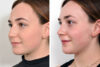 Rhinoplasty case #4173 slider thumbnail