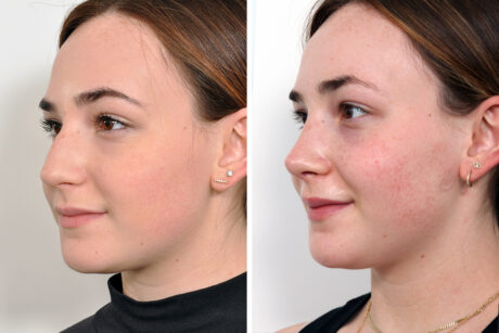 Rhinoplasty case #4173