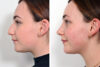 Rhinoplasty case #4173 slider thumbnail
