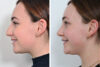 Rhinoplasty case #4173 slider thumbnail
