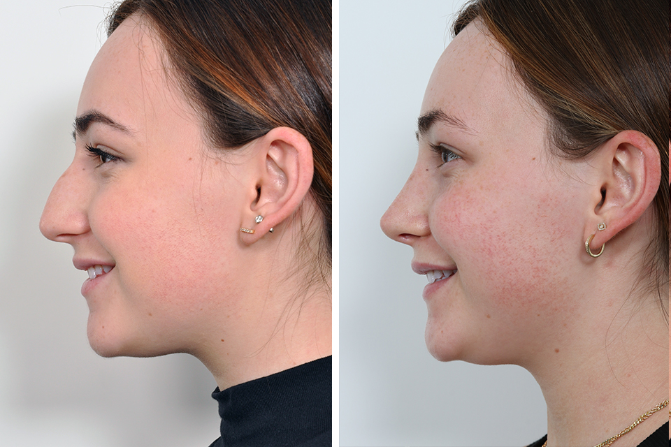 Rhinoplasty case #4173
