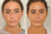 Rhinoplasty case #3940 slider thumbnail
