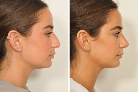 Rhinoplasty case #3940