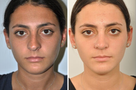 Rhinoplasty case #4192