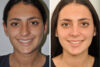Rhinoplasty case #4192 slider thumbnail